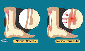 “Achilles Tendonitis Stretching Routines for Flexibility and Pain Relief”
