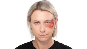 “Abrasion Ointments: Homemade, Antibacterial Remedies for Infection Prevention”