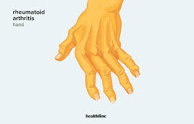 Arthritis Relief Turmeric-Ginger Tea