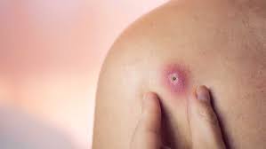 “Abscess Clay Treatments: Natural Clays to Draw Out Infections”