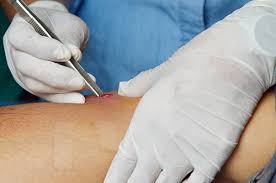 “Abscess Tea Tree Oil Solutions: Potent Antiseptic Remedies”