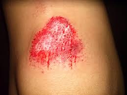 “Abrasion Healing Salves: Soothing and Protecting Skin Naturally”