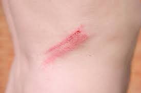 “Abrasion Scar Prevention: Herbal Remedies to Minimize Scarring”