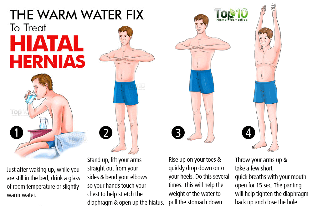 Home Remedies for Hiatal Hernias