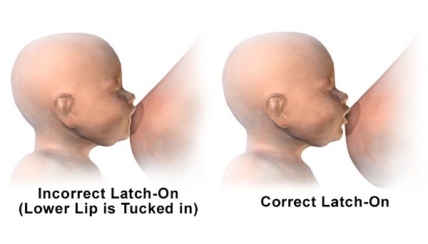 Home Remedies for Sore Nipples