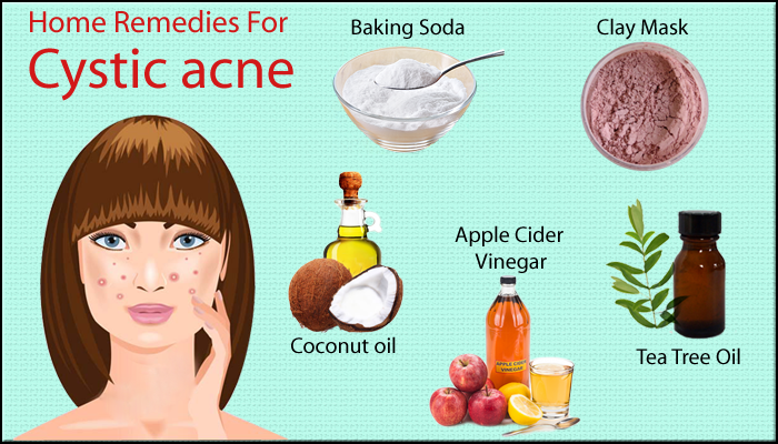 Home Remedies for Cystic Acne